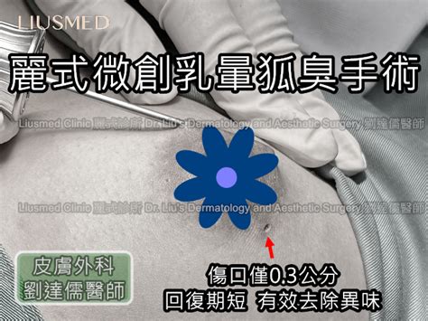 乳暈意思